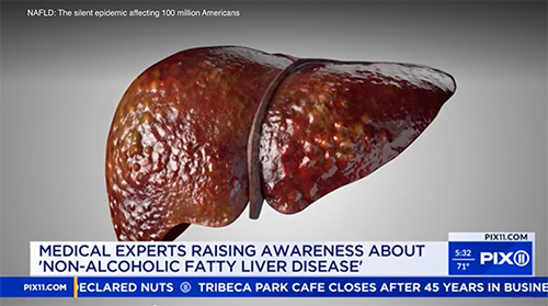 Non-alcoholic fatty liver disease Non-alcoholic fatty liver disease