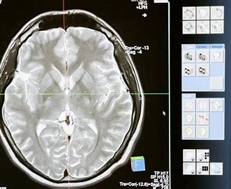 Focused Ultrasound of the Brain Focused Ultrasound of the Brain
